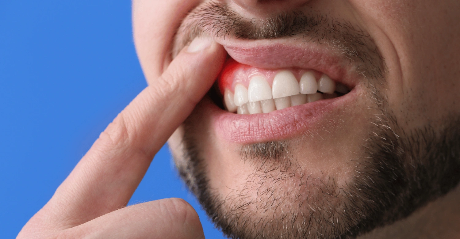 ADHD and gum disease inblog